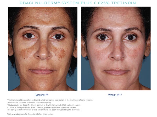 obagi skin care tretinoin