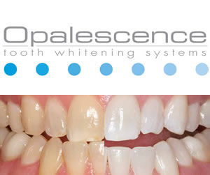 before and after teeth whitening with opalescence