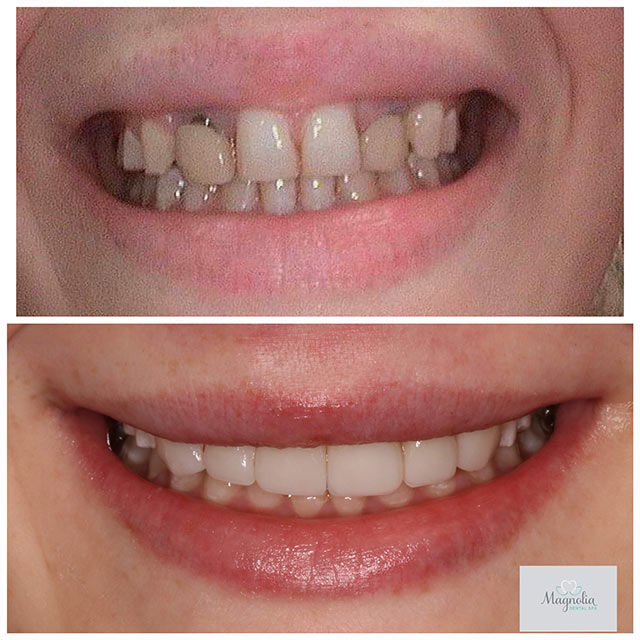 before and after dental implants