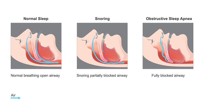 illustration of a normal airway, a restricted airway while snoring, and a blocked airway due to sleep apnea